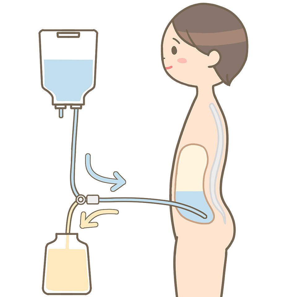 腹膜透析イメージ